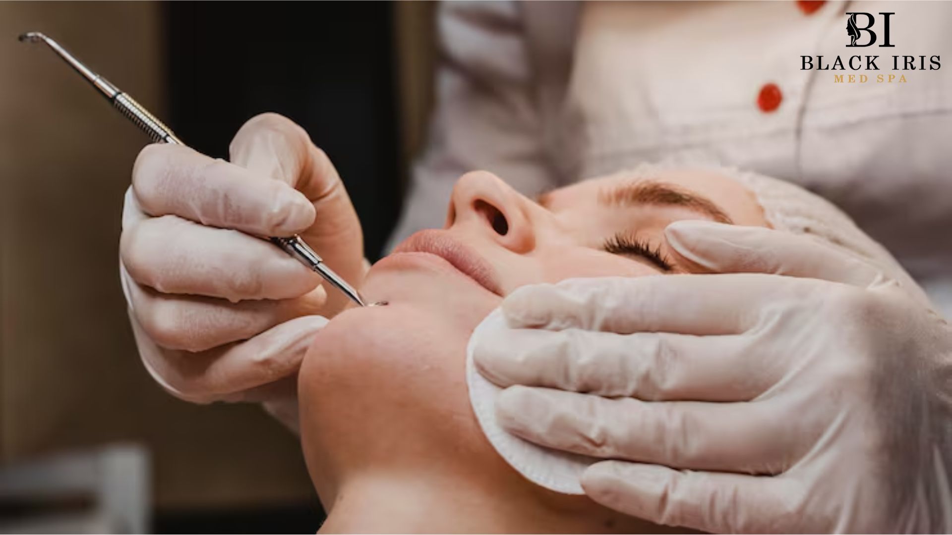Acne Scars Treatment Plano: Options for Smoother, Clearer Skin